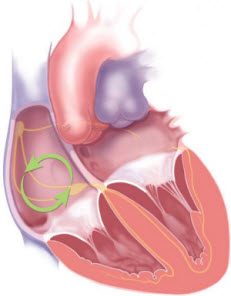 Atrial tach