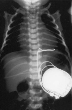 AbdominalImplant