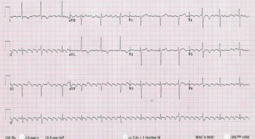 Atrail Flutter ECG