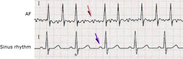BioMonitor 2 signals