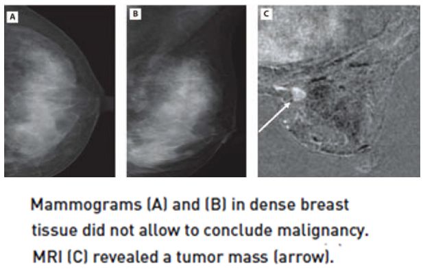 X-ray vs MRI breast