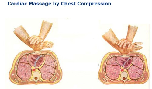 CardiacMasage