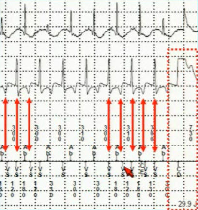 Dixit T wave oversensing