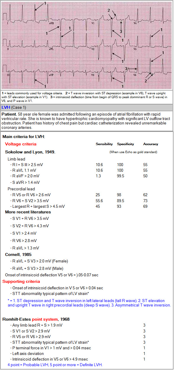 LV Hypẻtrphy ECG