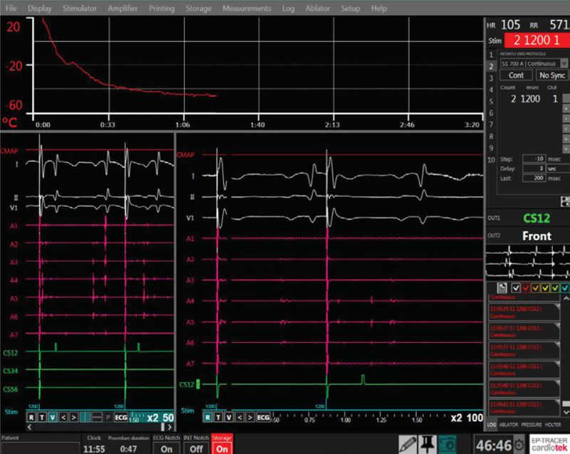 Successful CryoAblation screen