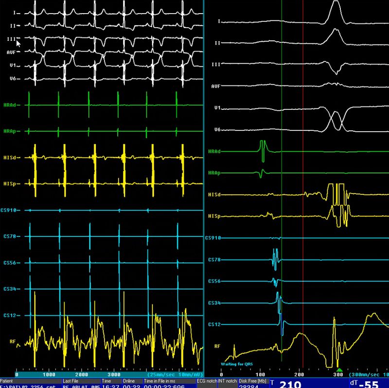 Ep-Tracer WPW
