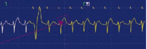GE T-wave Alternans