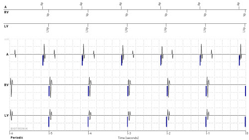 Periodic IEGM