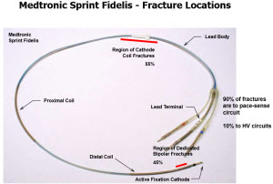 Fidelis fracture location