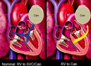 removing SVC shock coil