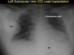left subclavian shock coil
