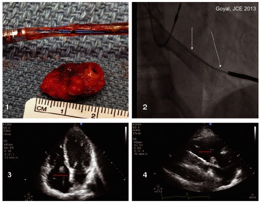 thrombus