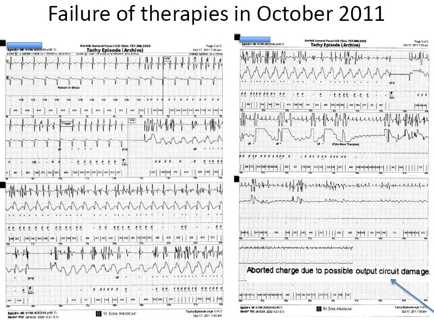 Riata Rx failure