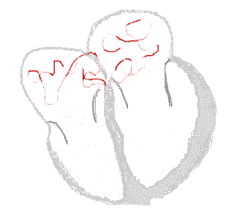 AFib