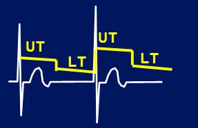 ICD auto threshold