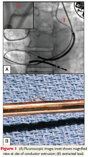 Linox externalized