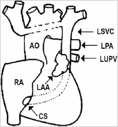 PLSVC