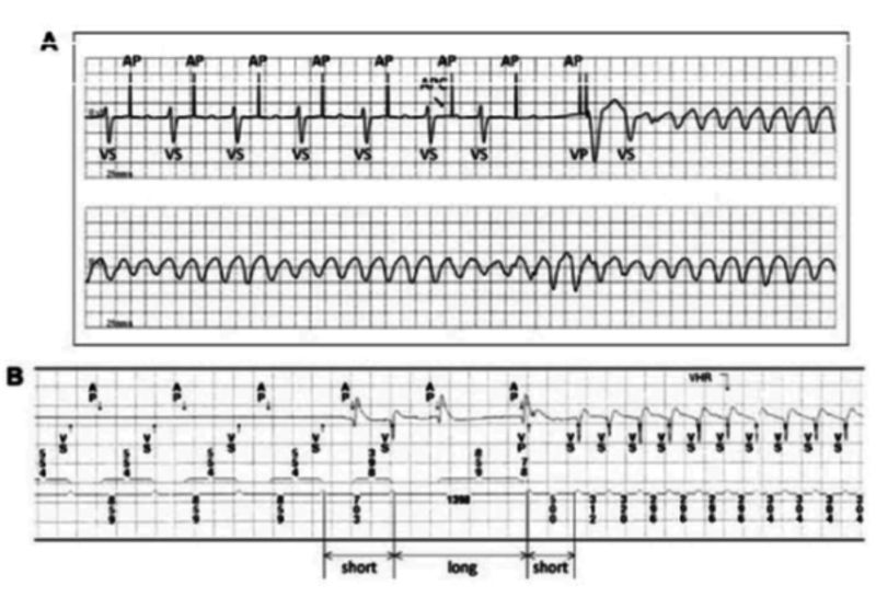Block I & intermittent II