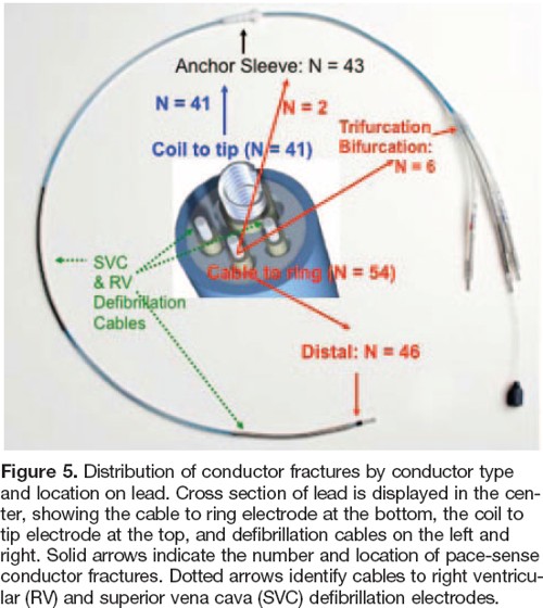 FidelisFracture