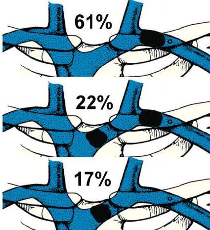 Occlusion location