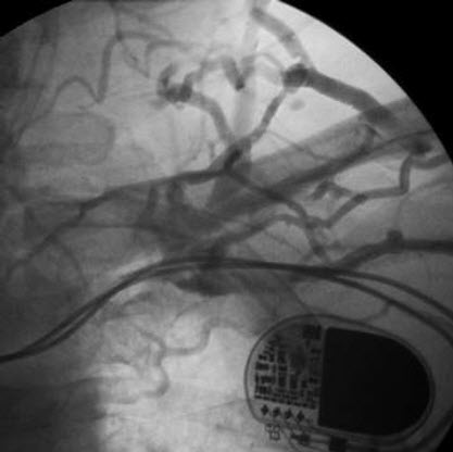 Venous occlusion