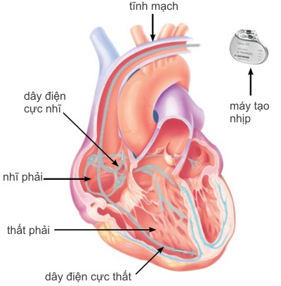 PM