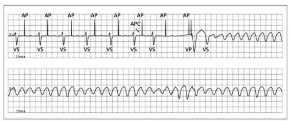 MVP pacing causes VF