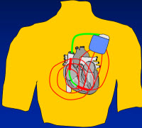 2 coil shock path