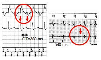 T wave oversensing: before and after