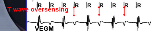 T wave oversensing