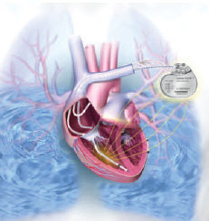 Thoracic Impedance