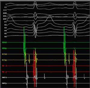 Ep-Tracer signals