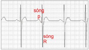 BioMonitor Waveform