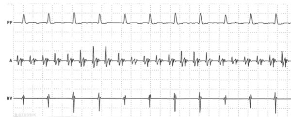 Atral fibrillation