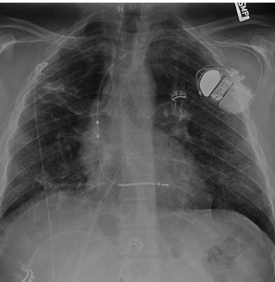 Cht x-ray S DX