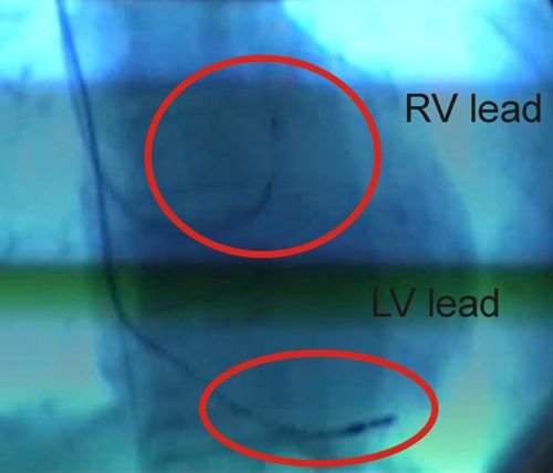 VerticalHeartCRT