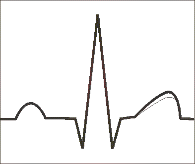 alternans
